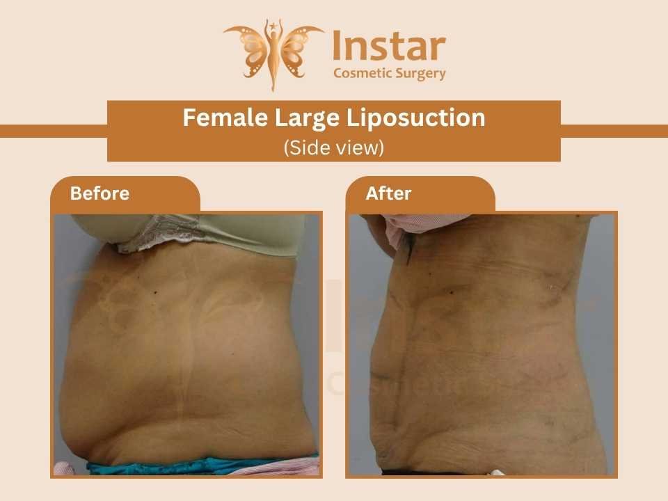 Female Large Liposuction (Side view)-2